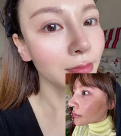 水分离水玻璃祛黄褐斑真皮斑新技术是由生物分...