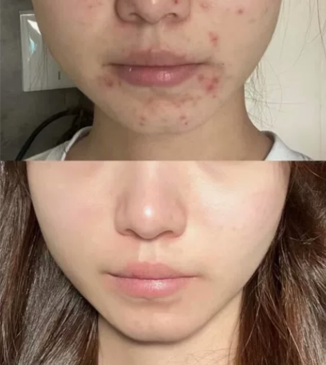 本人亲测有效 最适合痘痘肌用 最重要的是不...