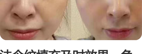 法令纹填充及时效果，免费教学，包教包会！ ...