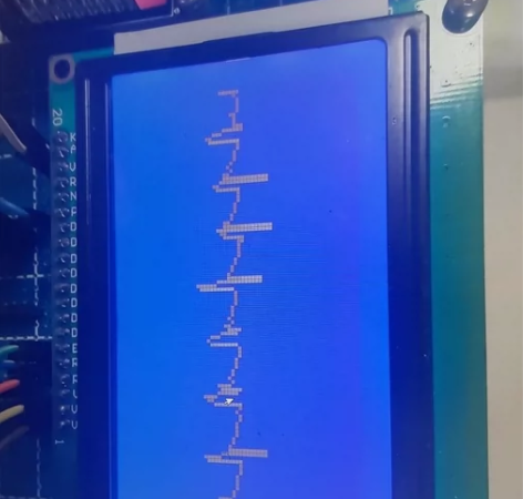 基于stm32的便携式心电图仪 人体心电检...
